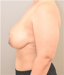 Breast Lift Before Photo by Keshav Magge, MD; Bethesda, MD - Case 44734