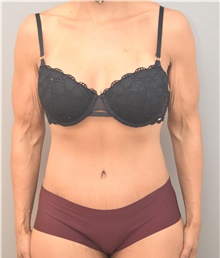 Tummy Tuck After Photo by Keshav Magge, MD; Bethesda, MD - Case 44763