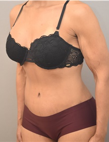 Tummy Tuck After Photo by Keshav Magge, MD; Bethesda, MD - Case 44763
