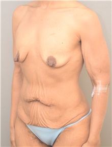 Tummy Tuck Before Photo by Keshav Magge, MD; Bethesda, MD - Case 44763