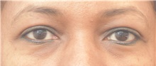 Eyelid Surgery After Photo by Keshav Magge, MD; Bethesda, MD - Case 44764