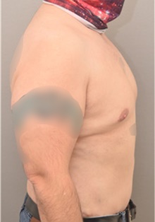 Male Breast Reduction After Photo by Keshav Magge, MD; Bethesda, MD - Case 44806