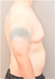 Male Breast Reduction Before Photo by Keshav Magge, MD; Bethesda, MD - Case 44806
