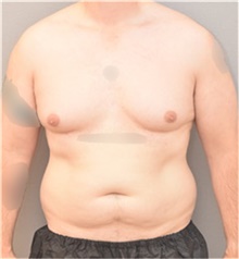 Tummy Tuck Before Photo by Keshav Magge, MD; Bethesda, MD - Case 44807