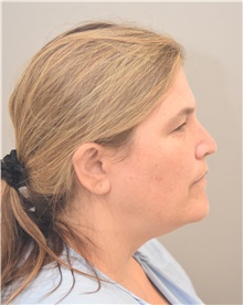 Facelift Before Photo by Keshav Magge, MD; Bethesda, MD - Case 44808