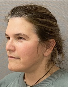 Neck Lift After Photo by Keshav Magge, MD; Bethesda, MD - Case 44809