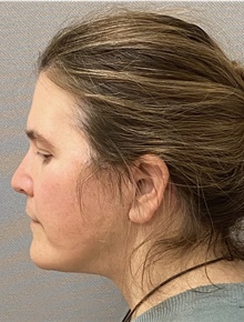 Neck Lift After Photo by Keshav Magge, MD; Bethesda, MD - Case 44809