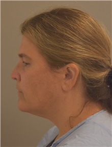 Neck Lift Before Photo by Keshav Magge, MD; Bethesda, MD - Case 44809