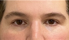 Eyelid Surgery After Photo by Keshav Magge, MD; Bethesda, MD - Case 44810