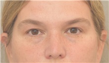 Eyelid Surgery Before Photo by Keshav Magge, MD; Bethesda, MD - Case 44810
