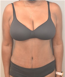 Tummy Tuck After Photo by Keshav Magge, MD; Bethesda, MD - Case 44926