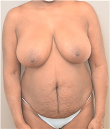 Tummy Tuck Before Photo by Keshav Magge, MD; Bethesda, MD - Case 44926