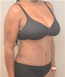 Tummy Tuck After Photo by Keshav Magge, MD; Bethesda, MD - Case 44926