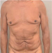 Tummy Tuck Before Photo by Keshav Magge, MD; Bethesda, MD - Case 44927