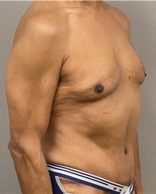 Tummy Tuck After Photo by Keshav Magge, MD; Bethesda, MD - Case 44927