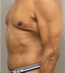 Tummy Tuck After Photo by Keshav Magge, MD; Bethesda, MD - Case 44927