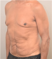 Tummy Tuck Before Photo by Keshav Magge, MD; Bethesda, MD - Case 44927