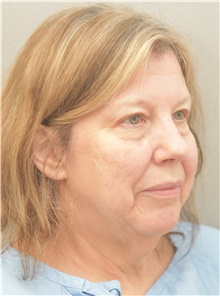 Facelift Before Photo by Keshav Magge, MD; Bethesda, MD - Case 44928