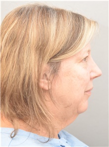 Facelift Before Photo by Keshav Magge, MD; Bethesda, MD - Case 44928
