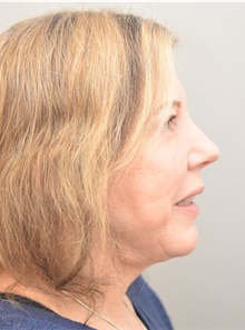 Neck Lift After Photo by Keshav Magge, MD; Bethesda, MD - Case 44929