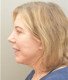 Neck Lift After Photo by Keshav Magge, MD; Bethesda, MD - Case 44929