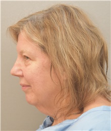 Neck Lift Before Photo by Keshav Magge, MD; Bethesda, MD - Case 44929