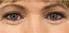Eyelid Surgery After Photo by Keshav Magge, MD; Bethesda, MD - Case 45616