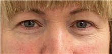 Eyelid Surgery Before Photo by Keshav Magge, MD; Bethesda, MD - Case 45616