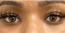 Eyelid Surgery After Photo by Keshav Magge, MD; Bethesda, MD - Case 45618