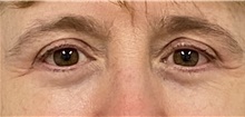Eyelid Surgery After Photo by Keshav Magge, MD; Bethesda, MD - Case 45619
