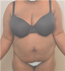 Tummy Tuck Before Photo by Keshav Magge, MD; Bethesda, MD - Case 45800