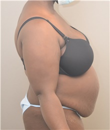 Tummy Tuck Before Photo by Keshav Magge, MD; Bethesda, MD - Case 45800