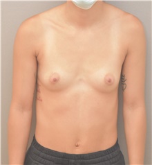 Breast Augmentation Before Photo by Keshav Magge, MD; Bethesda, MD - Case 45801