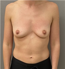 Breast Augmentation Before Photo by Keshav Magge, MD; Bethesda, MD - Case 45802