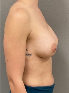 Breast Augmentation After Photo by Keshav Magge, MD; Bethesda, MD - Case 45802