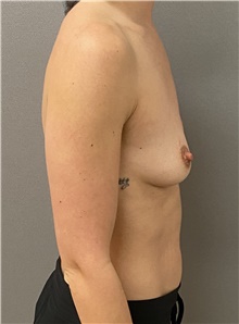 Breast Augmentation Before Photo by Keshav Magge, MD; Bethesda, MD - Case 45802
