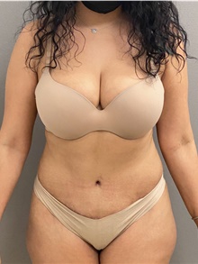 Tummy Tuck After Photo by Keshav Magge, MD; Bethesda, MD - Case 45803