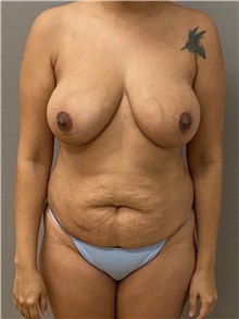 Tummy Tuck Before Photo by Keshav Magge, MD; Bethesda, MD - Case 45803
