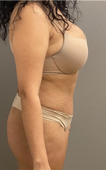 Tummy Tuck After Photo by Keshav Magge, MD; Bethesda, MD - Case 45803
