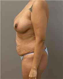 Tummy Tuck Before Photo by Keshav Magge, MD; Bethesda, MD - Case 45803