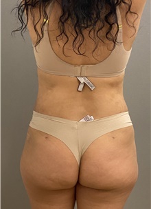 Buttock Lift with Augmentation After Photo by Keshav Magge, MD; Bethesda, MD - Case 45804