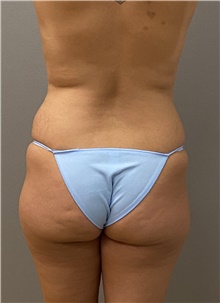 Buttock Lift with Augmentation Before Photo by Keshav Magge, MD; Bethesda, MD - Case 45804