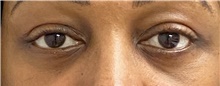 Eyelid Surgery After Photo by Keshav Magge, MD; Bethesda, MD - Case 45807