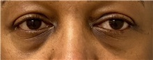 Eyelid Surgery Before Photo by Keshav Magge, MD; Bethesda, MD - Case 45807
