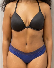 Tummy Tuck After Photo by Keshav Magge, MD; Bethesda, MD - Case 45813