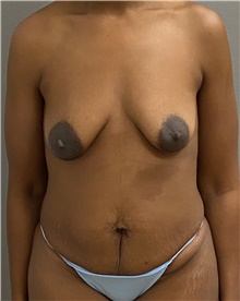 Tummy Tuck Before Photo by Keshav Magge, MD; Bethesda, MD - Case 45813