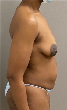 Tummy Tuck Before Photo by Keshav Magge, MD; Bethesda, MD - Case 45813