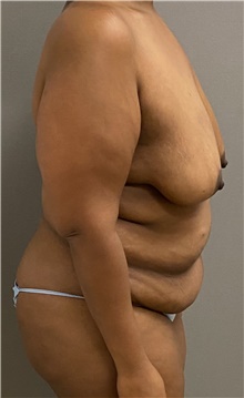 Breast Lift Before Photo by Keshav Magge, MD; Bethesda, MD - Case 45814