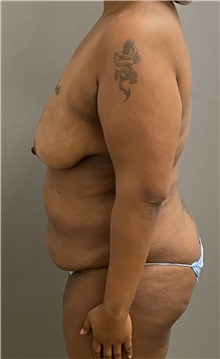 Breast Lift Before Photo by Keshav Magge, MD; Bethesda, MD - Case 45814