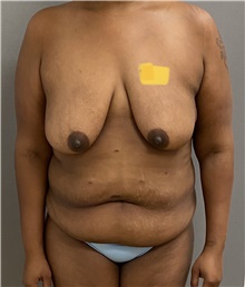 Breast Lift Before Photo by Keshav Magge, MD; Bethesda, MD - Case 45814